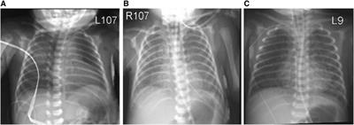 Case report: Fatal lung hyperinflammation in a preterm newborn with SARS-CoV-2 infection